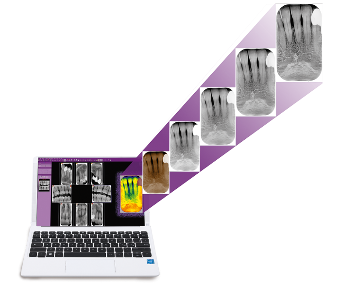 1000 Enveloppes Barrière Dentaire Numérique ScanX - 3,3 X 4,4 Cm - Pour Plaques Phosphore - Kit Neuf